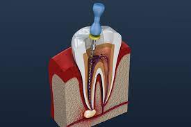 Can a Root Canal Fail