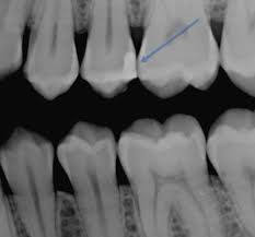 Cavities On Xray