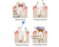 Failed Root Canal Symptoms