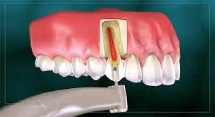 Front Tooth Root Canal