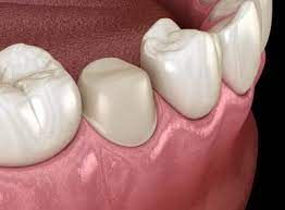 Root Canal Tooth Crown
