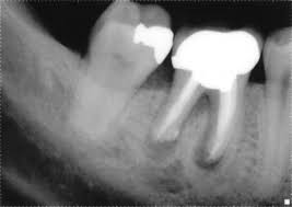 Root Canal Xray